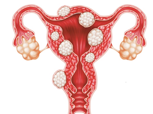 علاج دوالي الخصيتين والأورام الليفية في الرحم