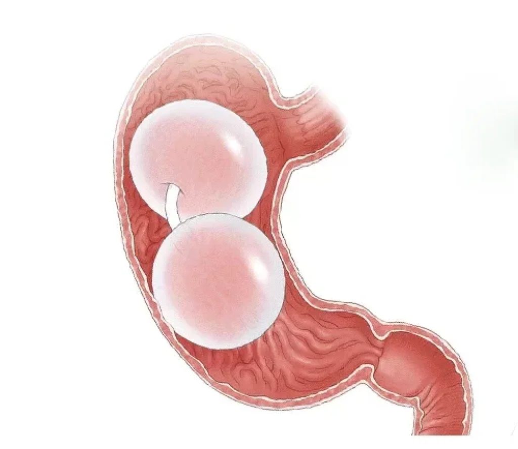 بالون المعدة للتخسيس في مصر